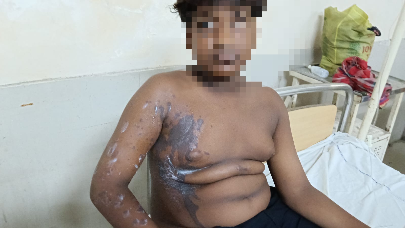 ময়ূরাক্ষী নদীতে স্নান করতে গিয়ে অ্যাসিড হামলার অভিযোগ, আহত তিন কিশোর, অভিযুক্ত মহিলা ধৃত